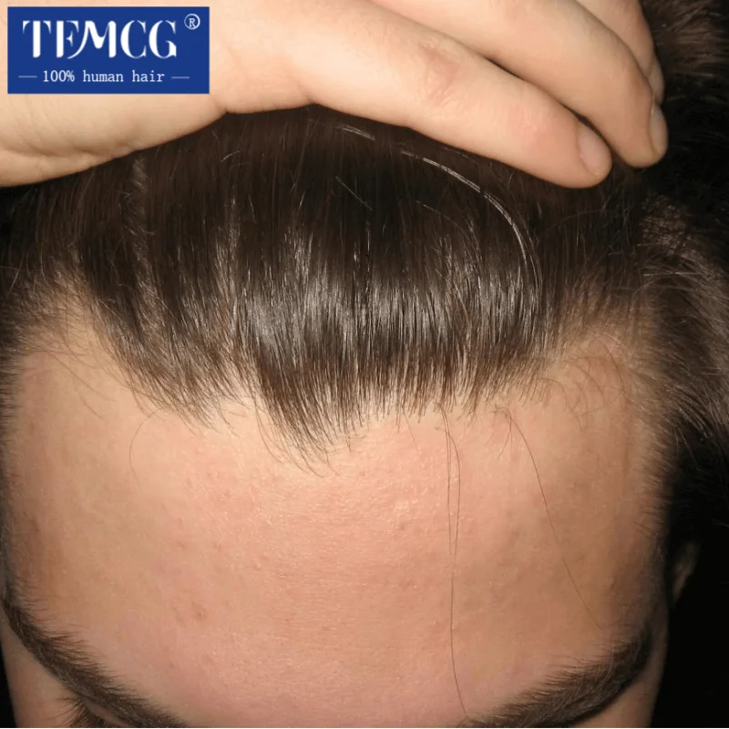Male Hair Prosthesis Invisible Hairline Men's Wig Ultra Thin Skin 0.02-0.03mm Toupee Men Wig 100% Human Hair Replacement System
Male Hair Prosthesis Invisible Hairline Men's Wig Ultra Thin Skin 0.02-0.03mm Toupee Men Wig 100% Human Hair Replacement System