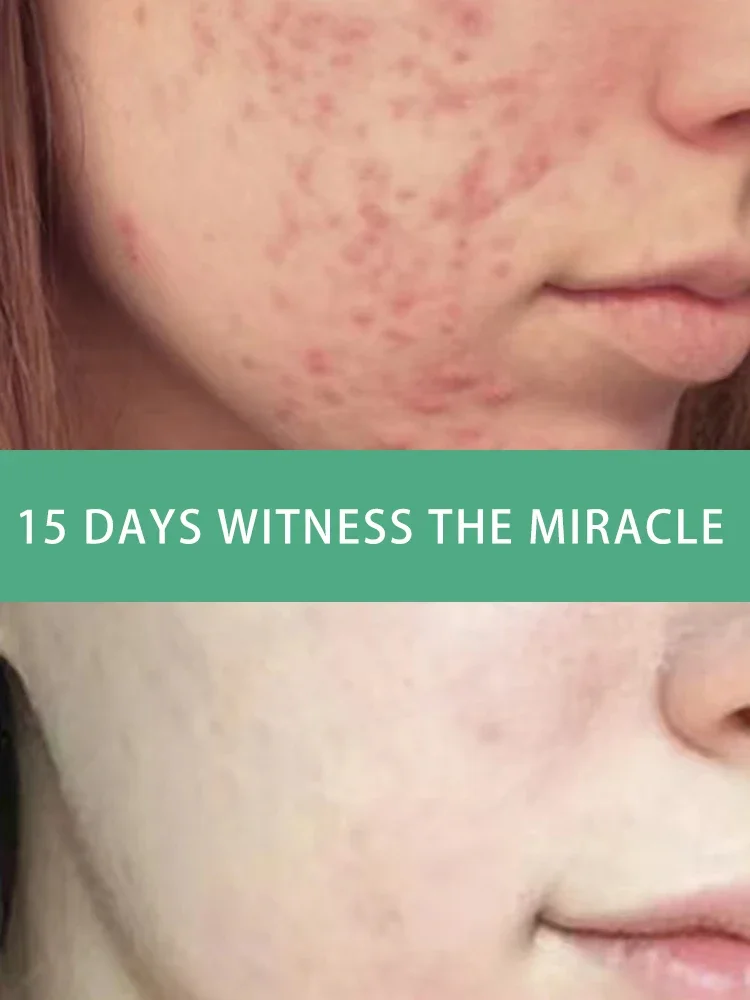 Herbal Acne Treatment Cream Face Scar Blackhead Remover Repair Gel Oil Control Shrink Pores Whitening Skin Care
Herbal Acne Treatment Cream Face Scar Blackhead Remover Repair Gel Oil Control Shrink Pores Whitening Skin Care