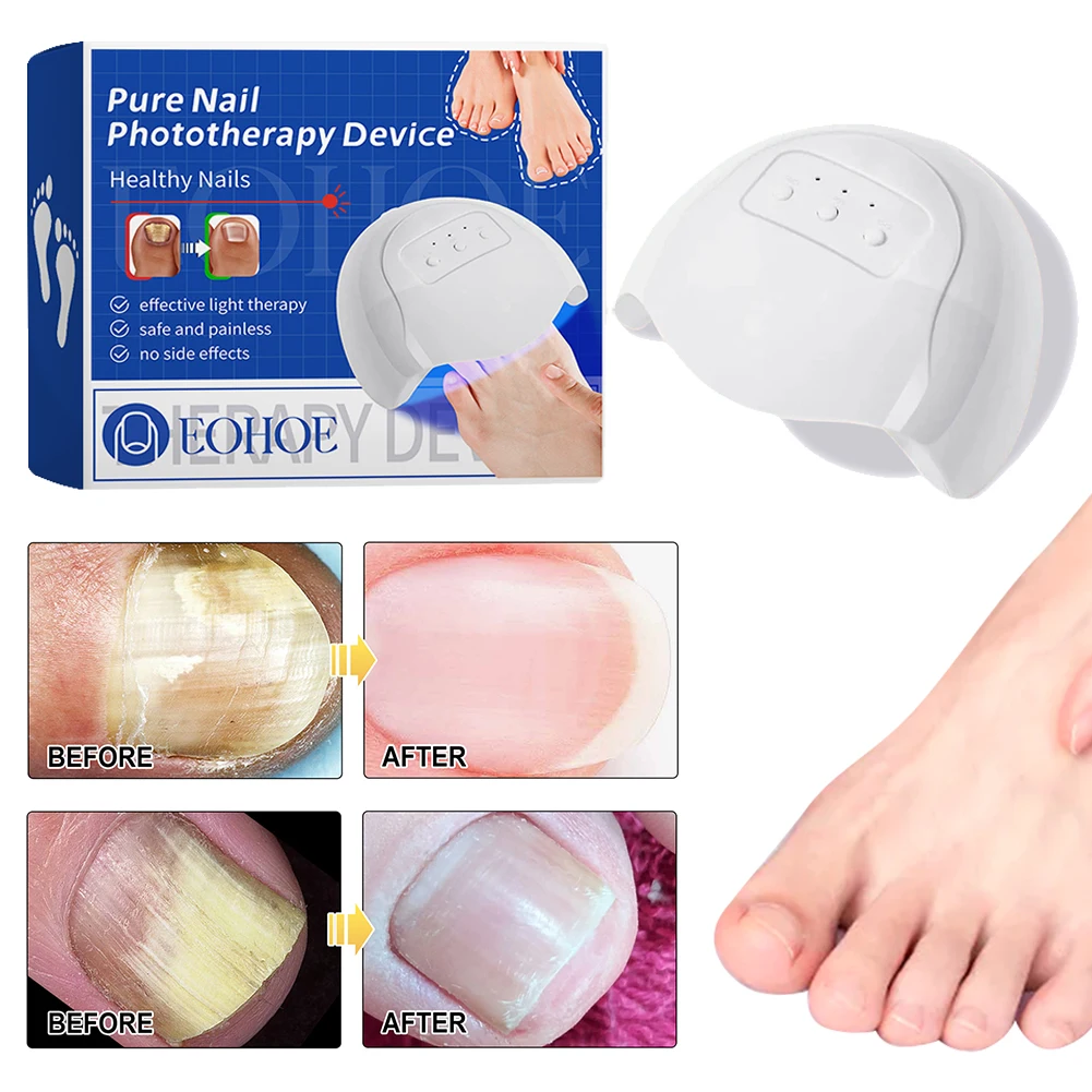 Nail Fungus Cleaning Device Home Use Nail-Fungus Remover Nail Fungus Therapy LED Light Device for Onychomycosis
Nail Fungus Cleaning Device Home Use Nail-Fungus Remover Nail Fungus Therapy LED Light Device for Onychomycosis