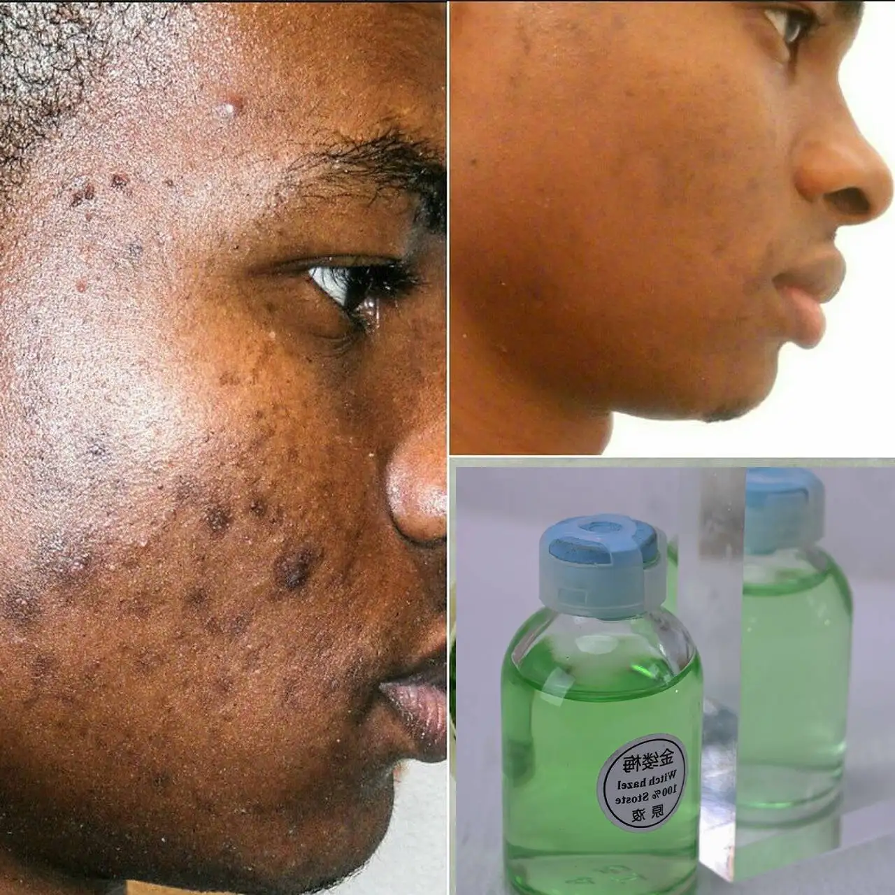 Natural Acne, Pimple, Blemish Spot Treatment Serum - Organic Acne Skin Care Remedy for Pimple Breakouts Acne Treatment Skin Care
Natural Acne, Pimple, Blemish Spot Treatment Serum - Organic Acne Skin Care Remedy for Pimple Breakouts Acne Treatment Skin Care