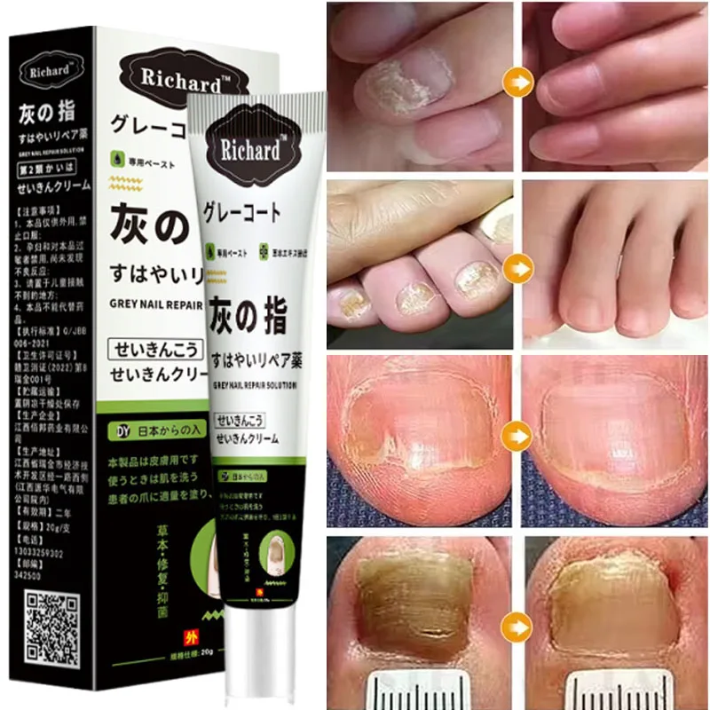 Nail Fungal Treatment Cream Foot Toe Nail Fungus Removal Essential Oil Anti Infection Onychomycosis Paronychia Repairing Care
Nail Fungal Treatment Cream Foot Toe Nail Fungus Removal Essential Oil Anti Infection Onychomycosis Paronychia Repairing Care