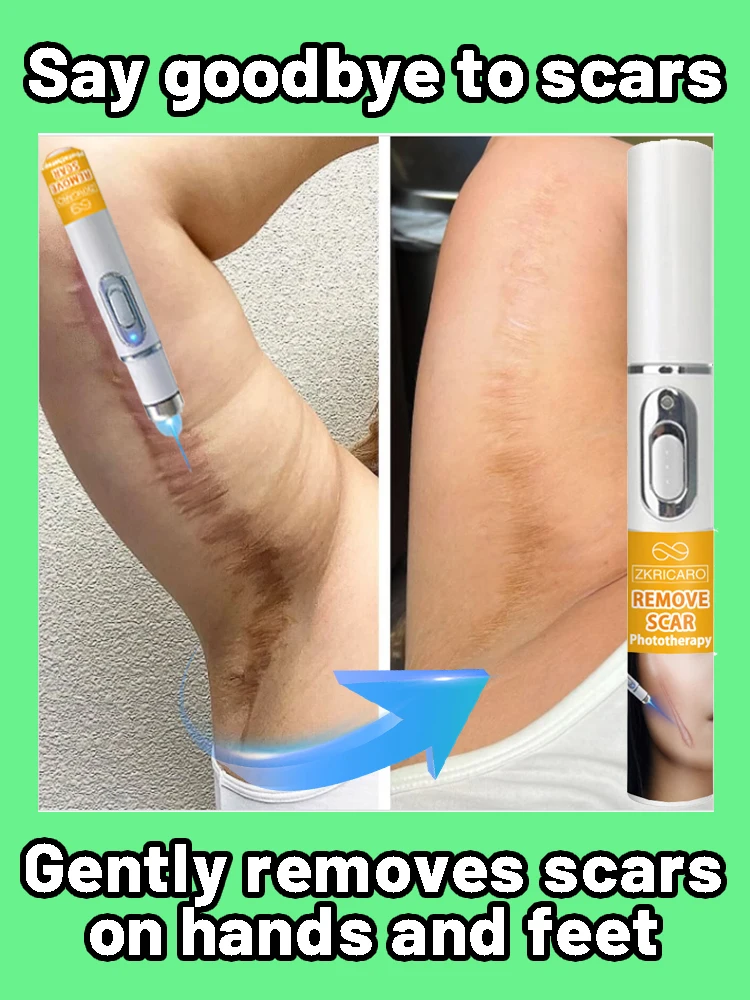 Удаление различных шрамов, хирургических шрамов, ожогов 
Удаление различных шрамов, хирургических шрамов, ожогов