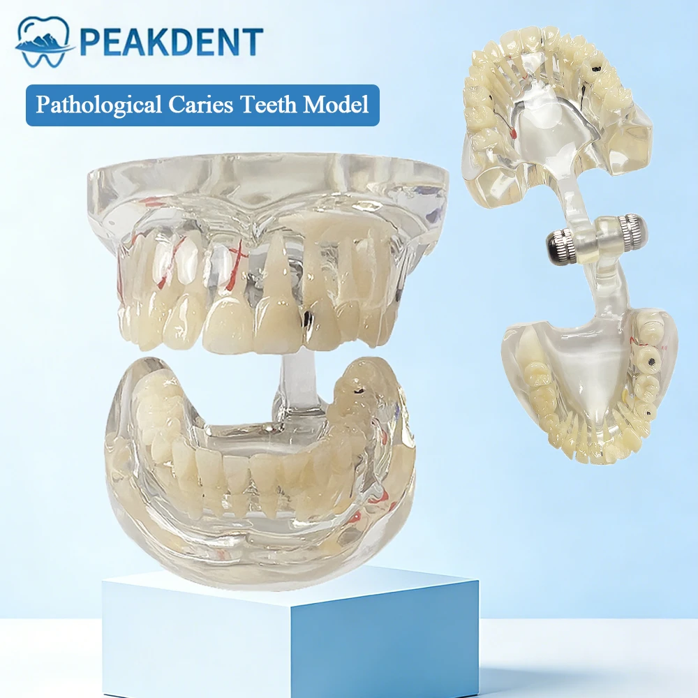Dental Pathological Caries Teeth Model With Implant Disease Teeth Dental Demonstration Model For Oral Pathology Research Patient
Dental Pathological Caries Teeth Model With Implant Disease Teeth Dental Demonstration Model For Oral Pathology Research Patient