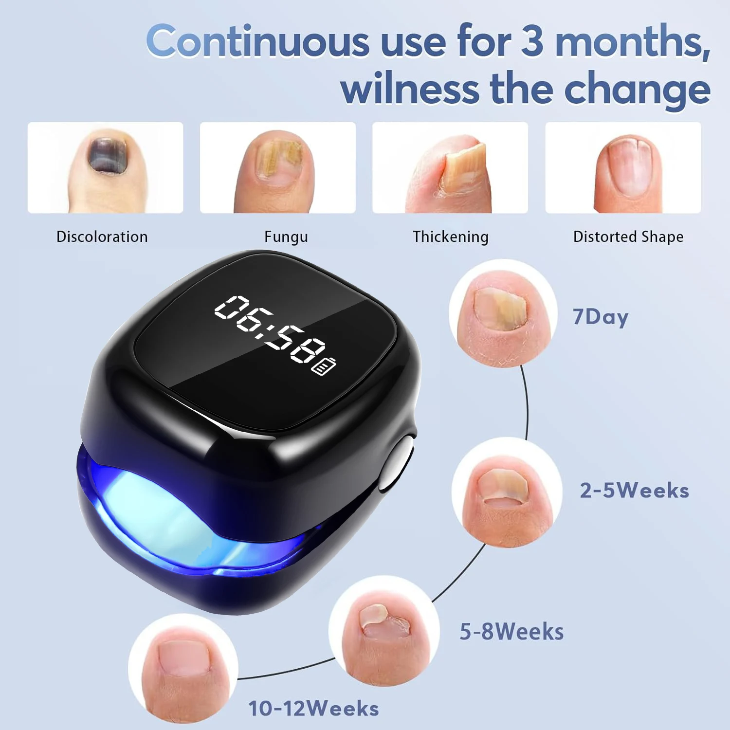 Onychomycosis instrument Portable Nail Laser Fungus Device 1pcs Nail Fungus Remover Repair Damaged Discolored Thick Fingernails
Onychomycosis instrument Portable Nail Laser Fungus Device 1pcs Nail Fungus Remover Repair Damaged Discolored Thick Fingernails
