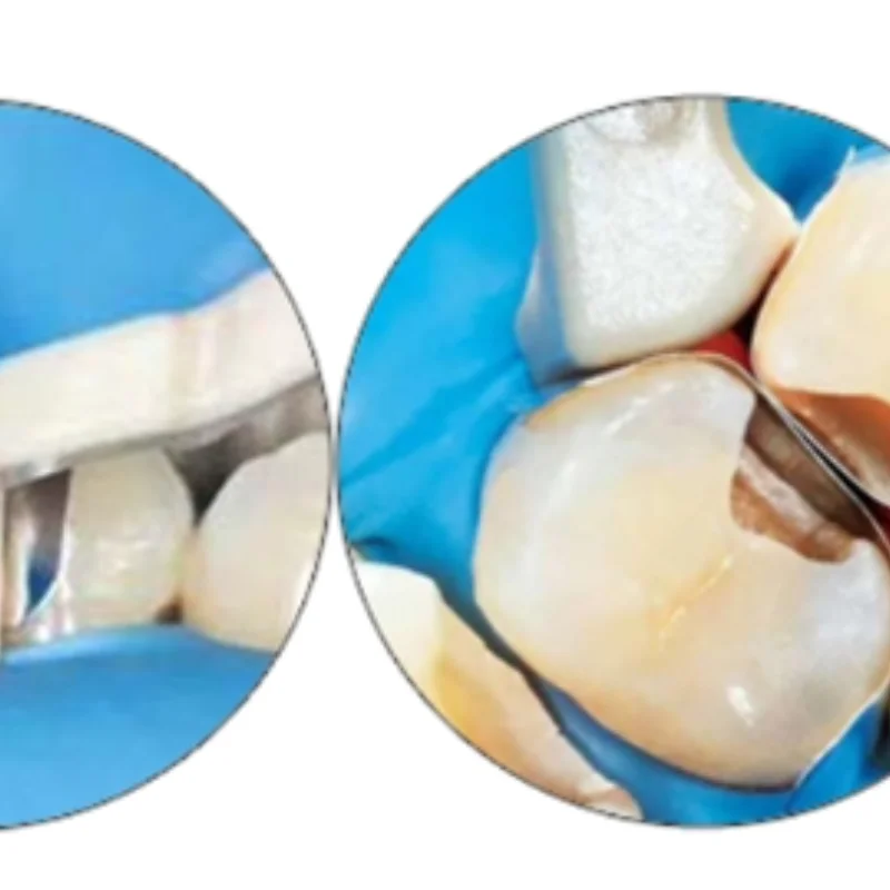 50Pcs Wooden Dental Interdental Wedge Disposable Tooth Gap Wedge with Specially Treated Tips for Gum Protection Dentist Supplies
50Pcs Wooden Dental Interdental Wedge Disposable Tooth Gap Wedge with Specially Treated Tips for Gum Protection Dentist Supplies