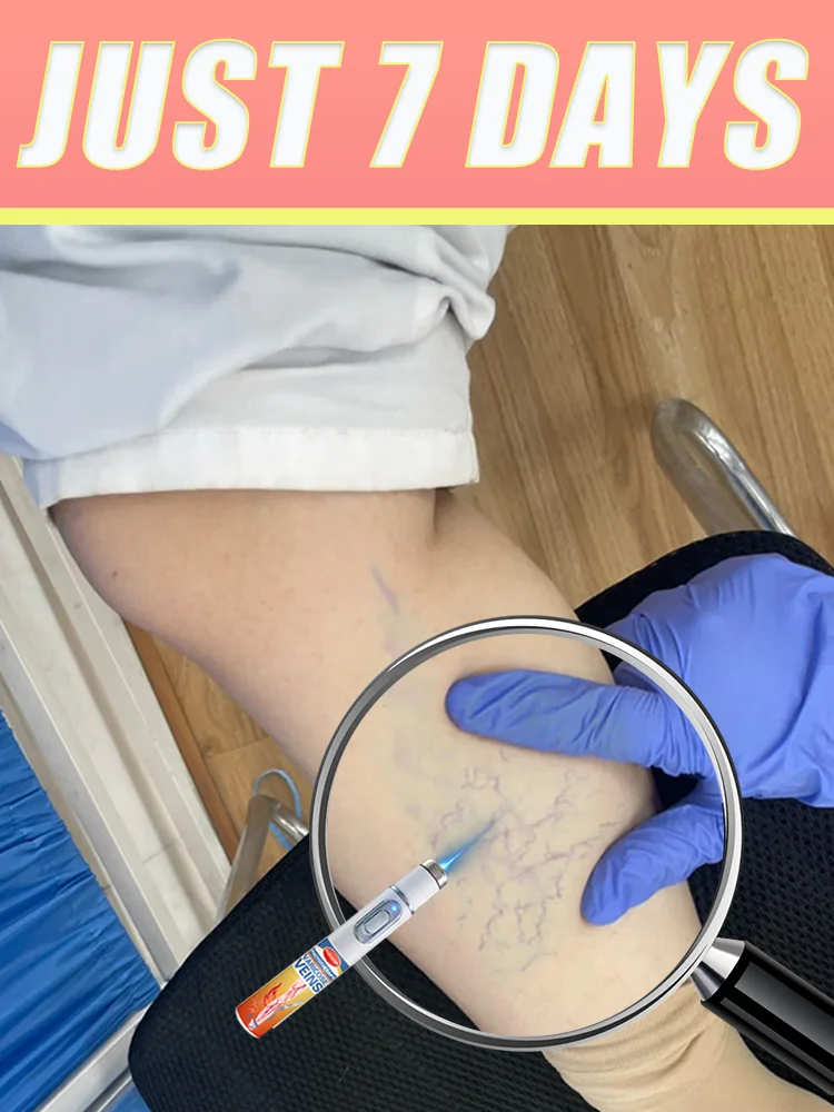 Bʟᴜᴇ ʟɪɢʜᴛ ᴘᴇɴ, ʀᴇʟɪᴇᴠᴇ ʟᴇɢ ᴘᴀɪɴ ᴀɴᴅ ʀᴇᴅᴜᴄᴇ "sᴘɪᴅᴇʀ ʟᴇɢs",sᴜᴘᴇʀ ᴘʀᴀᴄᴛɪᴄᴀʟ
Bʟᴜᴇ ʟɪɢʜᴛ ᴘᴇɴ, ʀᴇʟɪᴇᴠᴇ ʟᴇɢ ᴘᴀɪɴ ᴀɴᴅ ʀᴇᴅᴜᴄᴇ "sᴘɪᴅᴇʀ ʟᴇɢs",sᴜᴘᴇʀ ᴘʀᴀᴄᴛɪᴄᴀʟ