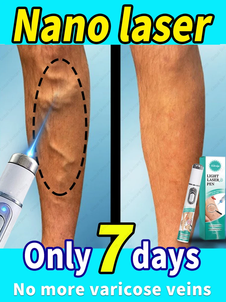 Eliminate vasculitis, phlebitis, relieve spider leg pain, varicose veins painless treatment
Eliminate vasculitis, phlebitis, relieve spider leg pain, varicose veins painless treatment
