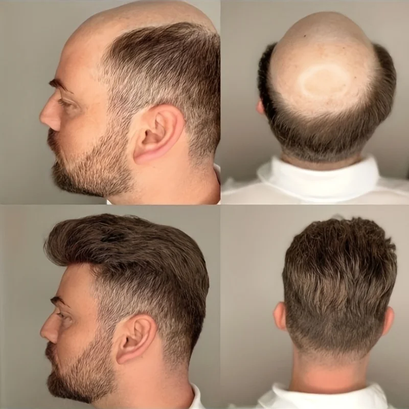 HOLLYWOOD Men's Hair Prosthesis - Swiss Lace 1/4" Polyskin Base, 120% Density Water Wave, Natural Hairline Secure Fit, 8x10 Inch
HOLLYWOOD Men's Hair Prosthesis - Swiss Lace 1/4" Polyskin Base, 120% Density Water Wave, Natural Hairline Secure Fit, 8x10 Inch