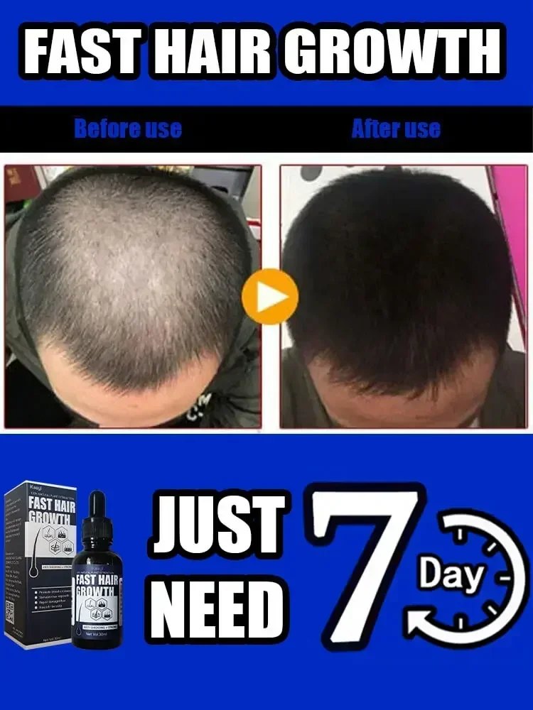 Faster Stronger Thicker Hair Growth | Clinically Tested for Thicker Hair | say goodbye to baldness
Faster Stronger Thicker Hair Growth | Clinically Tested for Thicker Hair | say goodbye to baldness