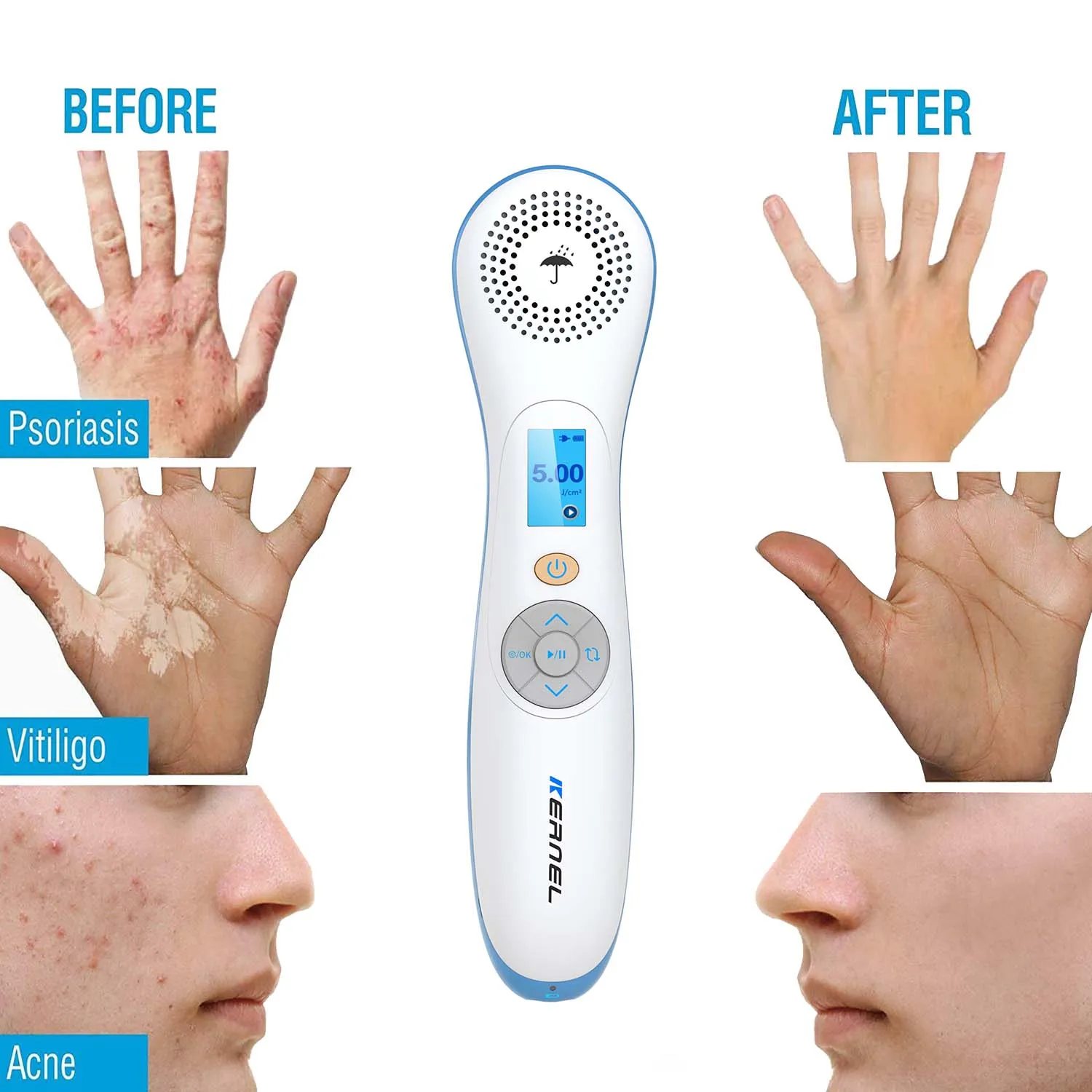Мощное устройство Vitiligo для ручного лица, нм, UVB, фототерапия, 311нм, uvb лампа, устройство для фототерапии, УФ-лампа для фототерапии
Мощное устройство Vitiligo для ручного лица, нм, UVB, фототерапия, 311нм, uvb лампа, устройство для фототерапии, УФ-лампа для фототерапии