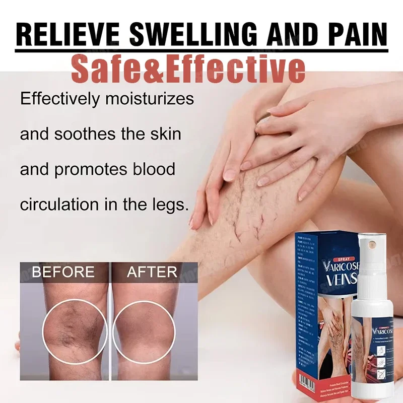 Powerful Varicose Vein Spray Natural Herb Veins Soothing Essential Oil Spray Vasculitis Phlebitis Spider Vein Earthworm Leg Cure
Powerful Varicose Vein Spray Natural Herb Veins Soothing Essential Oil Spray Vasculitis Phlebitis Spider Vein Earthworm Leg Cure
