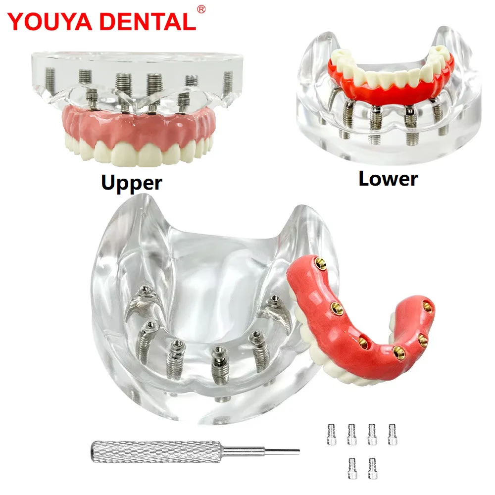 New 6 Implants Dental Teeth Model Implant Model Maryland Bridge Overdenture Restoration Typodont For Education Practice Training
New 6 Implants Dental Teeth Model Implant Model Maryland Bridge Overdenture Restoration Typodont For Education Practice Training