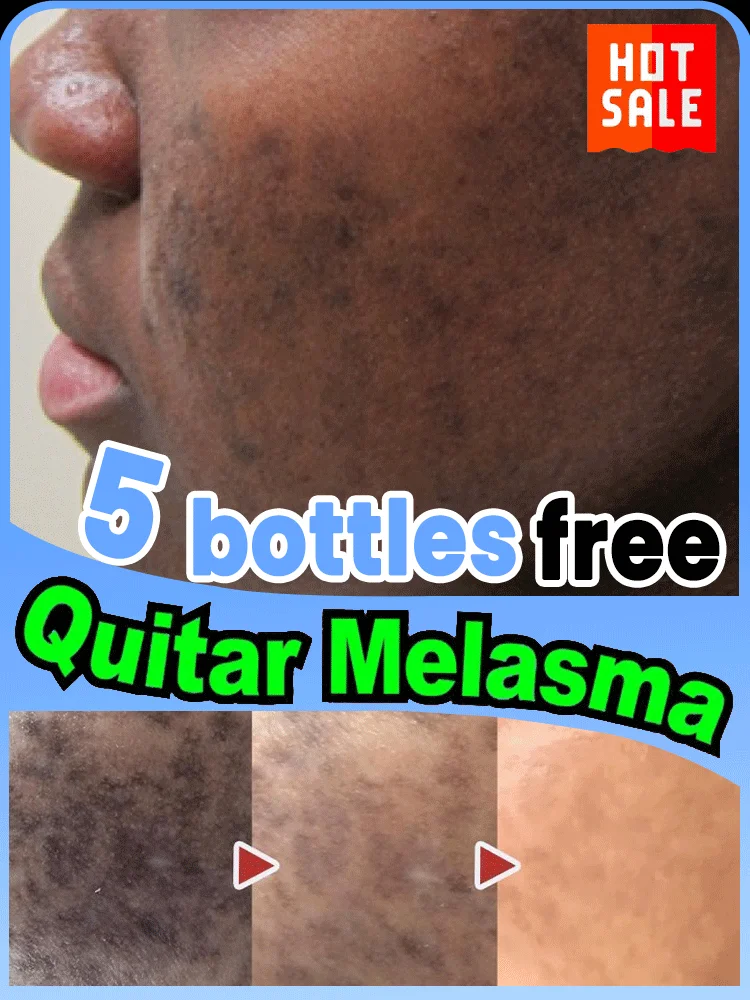Powerful Cream Fast Skin Lightening Solve Melasma Dark Spots Suitable for all ages
Powerful Cream Fast Skin Lightening Solve Melasma Dark Spots Suitable for all ages