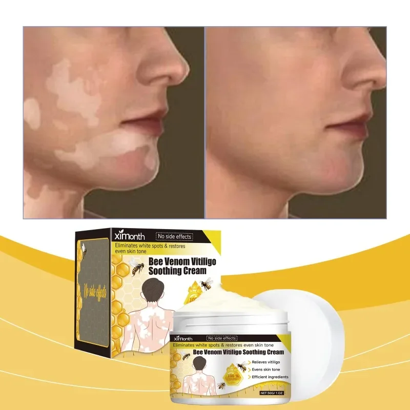 Bee Venom Vitiligo Soothing Cream Repair Leukoplakia Reduce Pigment Evens Skin Tone Treatment White Spot Disease Cream Body Care
Bee Venom Vitiligo Soothing Cream Repair Leukoplakia Reduce Pigment Evens Skin Tone Treatment White Spot Disease Cream Body Care