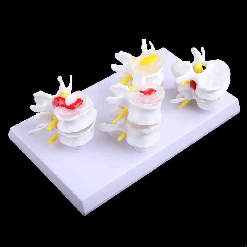 1 Set Human Lumbar Lesion Spine Statue Display Model Medical Teaching Learning Drop Shipping
1 Set Human Lumbar Lesion Spine Statue Display Model Medical Teaching Learning Drop Shipping