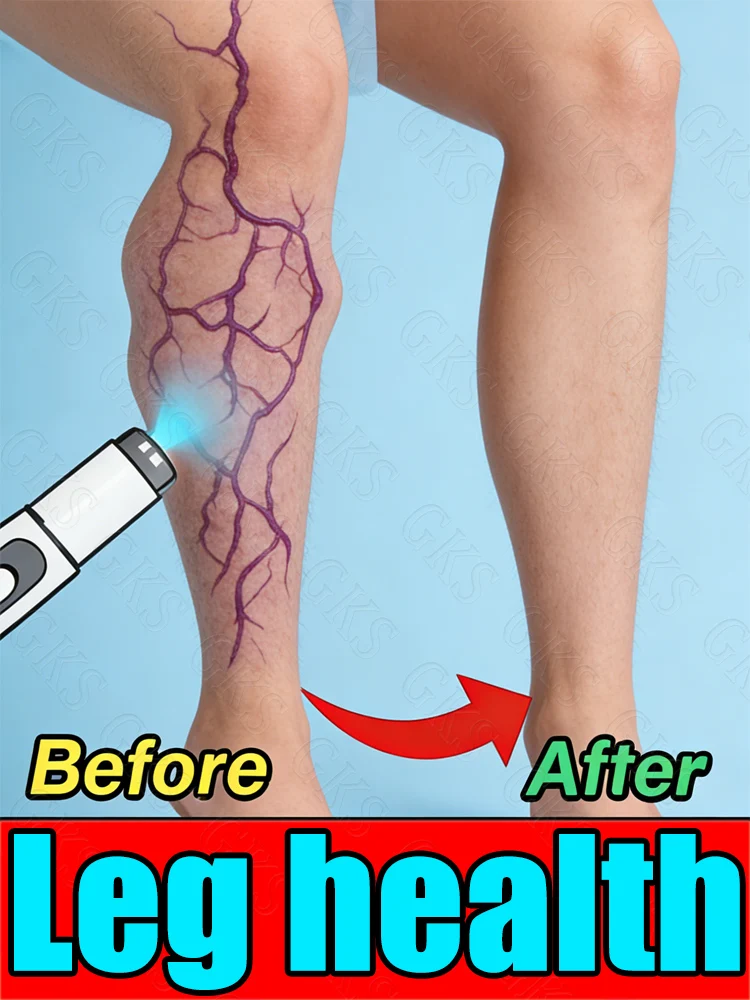 Лазерное лечение второго поколения: попрощайтесь с сосудистыми звездочками за 7 дней
Лазерное лечение второго поколения: попрощайтесь с сосудистыми звездочками за 7 дней