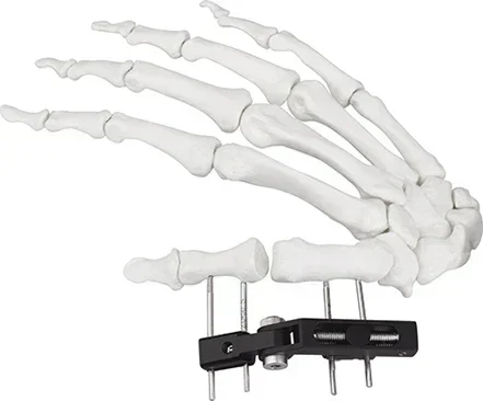 Chinese factory elbow joint external fixator
Chinese factory elbow joint external fixator