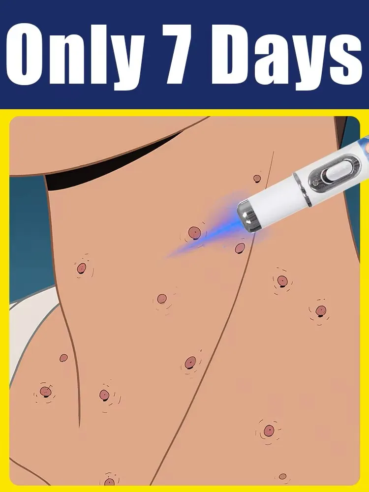 Blue light pen to solve warts, hot selling wart care tool
Blue light pen to solve warts, hot selling wart care tool