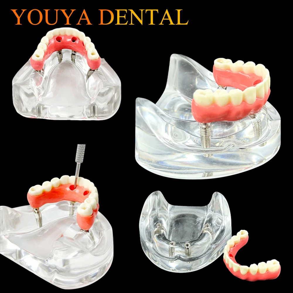 Implants Overdenture Restoration Model Transparent Lower Jaw Type Overdenture Educational Practice Training Study
Implants Overdenture Restoration Model Transparent Lower Jaw Type Overdenture Educational Practice Training Study