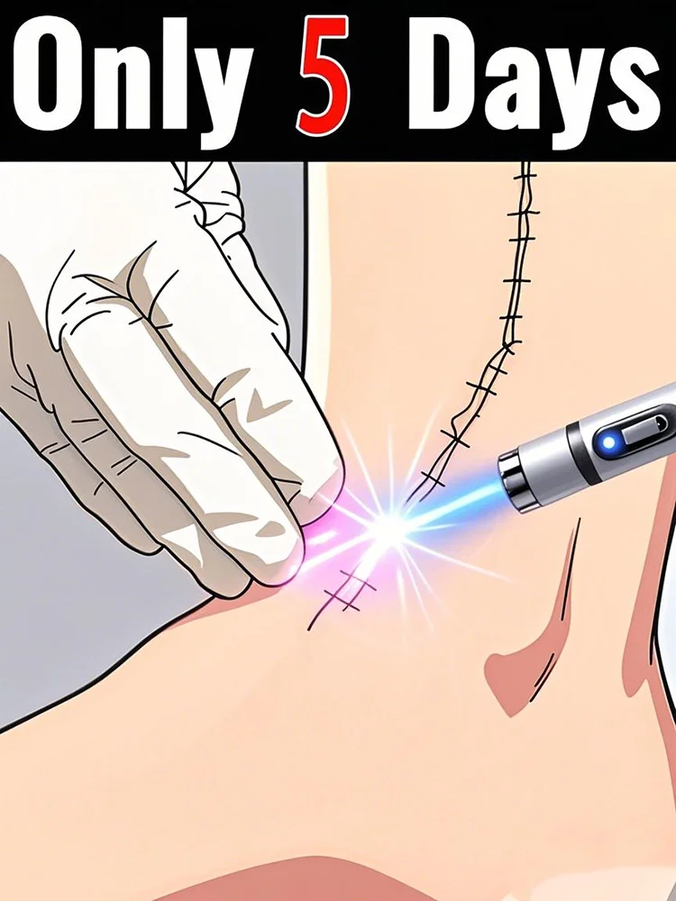 Синий лазер нанометрового уровня может EH aziразличные новые и старые шрамы
Синий лазер нанометрового уровня может EH aziразличные новые и старые шрамы