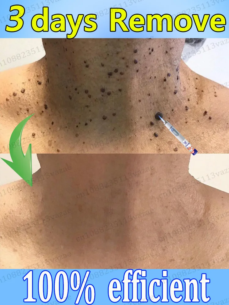Condyloma acuminatum zal niet langer naar jou komen 
Condyloma acuminatum zal niet langer naar jou komen