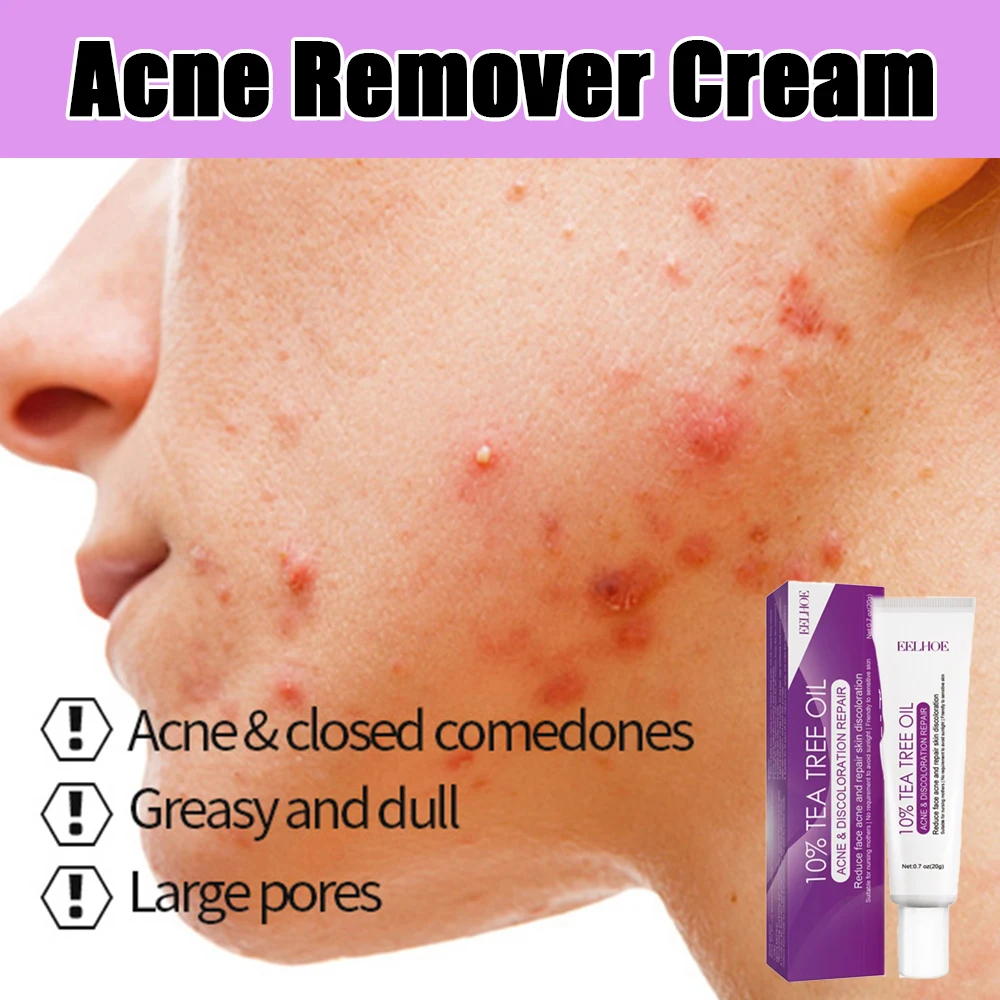 Acne Remover Face Cream with Pimple Removal, Pore Shrinking, and Oil Control Skin Care Solution
Acne Remover Face Cream with Pimple Removal, Pore Shrinking, and Oil Control Skin Care Solution