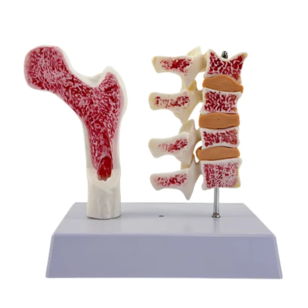 Anatomical surface of the leg bone in an anatomical model of human femoral osteoporosis
Anatomical surface of the leg bone in an anatomical model of human femoral osteoporosis