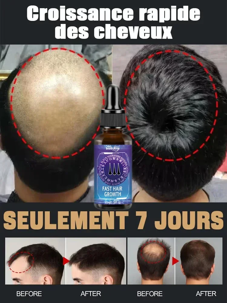 El aceite esencial más eficaz para el crecimiento del cabello, certificado por expertos autorizados, repara la calvicie
El aceite esencial más eficaz para el crecimiento del cabello, certificado por expertos autorizados, repara la calvicie