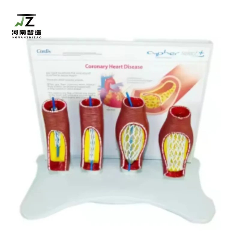 Coronary Heart Disease Human vascular occlusion stent model human cardiovascular and cerebrovascular occlusion
Coronary Heart Disease Human vascular occlusion stent model human cardiovascular and cerebrovascular occlusion