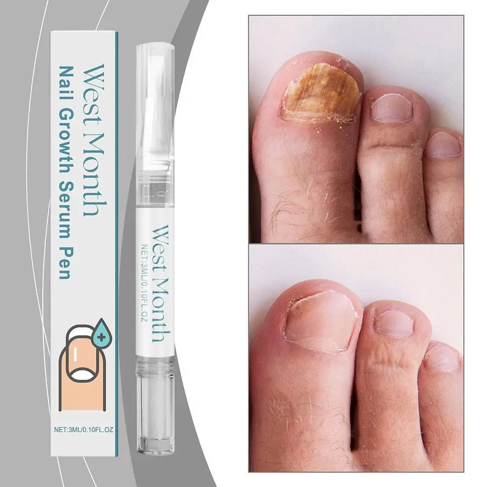 Nail Growth Serum Pen Cuticle Nutrition Solution Preventing Dryness And Peeling Nail Brittled Cracked Nail Care
Nail Growth Serum Pen Cuticle Nutrition Solution Preventing Dryness And Peeling Nail Brittled Cracked Nail Care