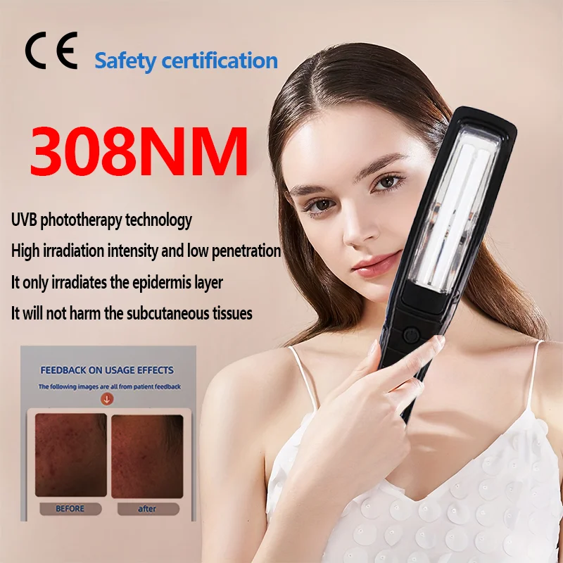 Uvb Vitiligo Physical Therapy Equipment - Narrow-Band Light Lamp Medical Light Source - Uv311nm Psoriasis And Eczema Therapy
Uvb Vitiligo Physical Therapy Equipment - Narrow-Band Light Lamp Medical Light Source - Uv311nm Psoriasis And Eczema Therapy