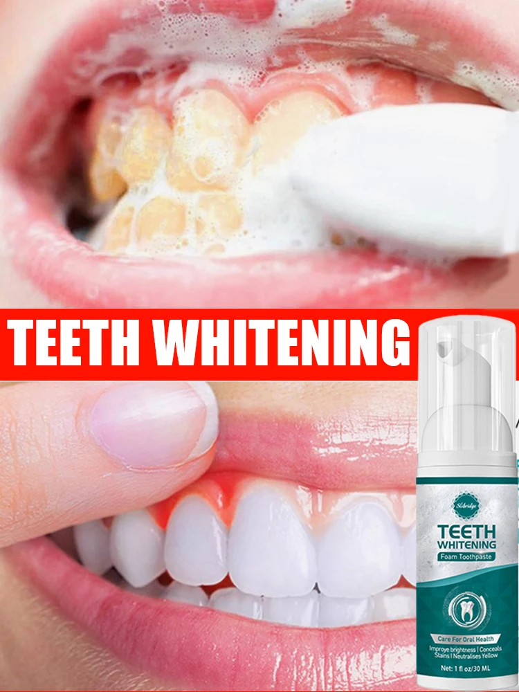 Teeth whitening mousse, preventing tooth decay, removing yellow teeth, and refreshing the mouth
Teeth whitening mousse, preventing tooth decay, removing yellow teeth, and refreshing the mouth
