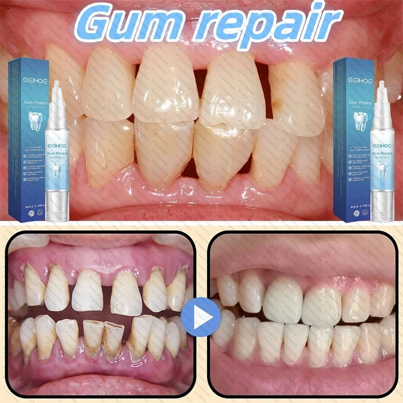 Rapid Repair Damaged Gums Gel Serum Relieve Sore Tooth Allergy Dental Caries Tooth Cleaning Toothpaste Deep Cleaning Teeth Stain
Rapid Repair Damaged Gums Gel Serum Relieve Sore Tooth Allergy Dental Caries Tooth Cleaning Toothpaste Deep Cleaning Teeth Stain