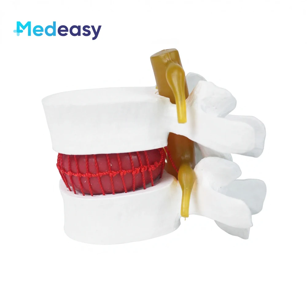 Human Lumbar Spine Herniation Pathology Model Plastic Intervertebral Disc Skeleton Model for Medical Science
Human Lumbar Spine Herniation Pathology Model Plastic Intervertebral Disc Skeleton Model for Medical Science