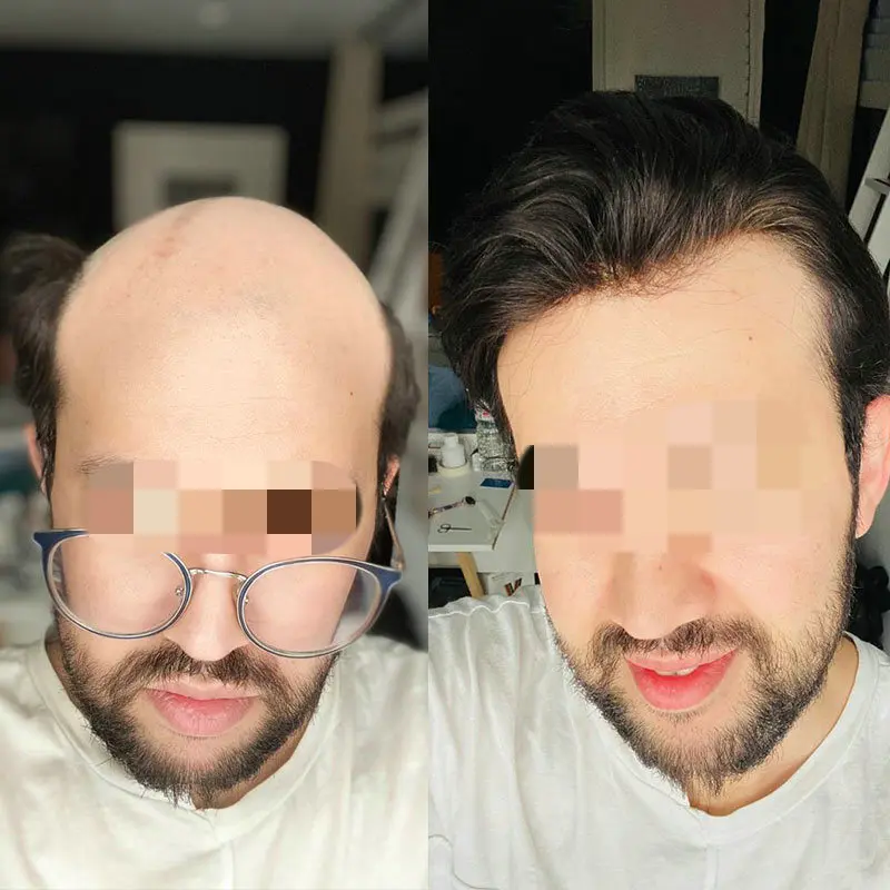 Hstonir натуральный черный 6x8 "парик из силиконового кружева спереди с пу вокруг 1B, индийская замена волос Remy для мужской системы волос H055
Hstonir натуральный черный 6x8 "парик из силиконового кружева спереди с пу вокруг 1B, индийская замена волос Remy для мужской системы волос H055