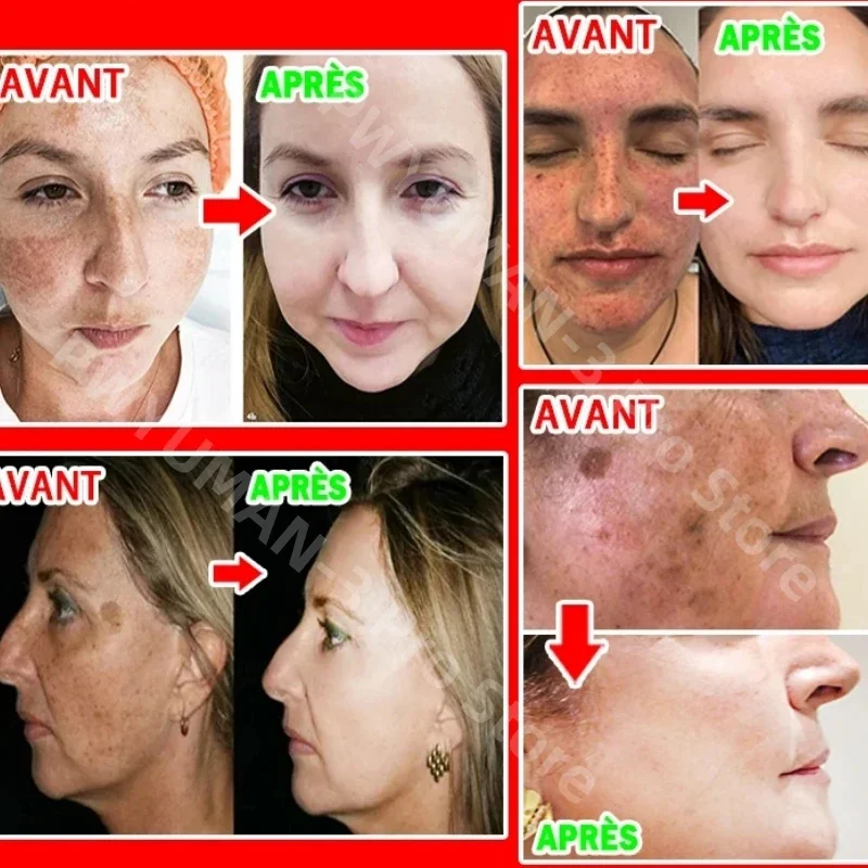 Отбеливающий крем для удаления пятен эффективно устраняет пигментацию меланина, осветляет мелазмы, темные пятна, мягкий осветляет корейский уход за кожей
Отбеливающий крем для удаления пятен эффективно устраняет пигментацию меланина, осветляет мелазмы, темные пятна, мягкий осветляет корейский уход за кожей