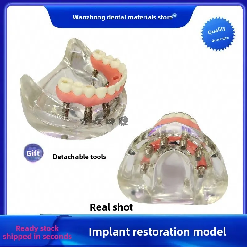 Dental Dental Model Ma Long Bridge Denture Restoration Implant Dental Simulation Demonstration Simulation Teaching Doctor-patien
Dental Dental Model Ma Long Bridge Denture Restoration Implant Dental Simulation Demonstration Simulation Teaching Doctor-patien