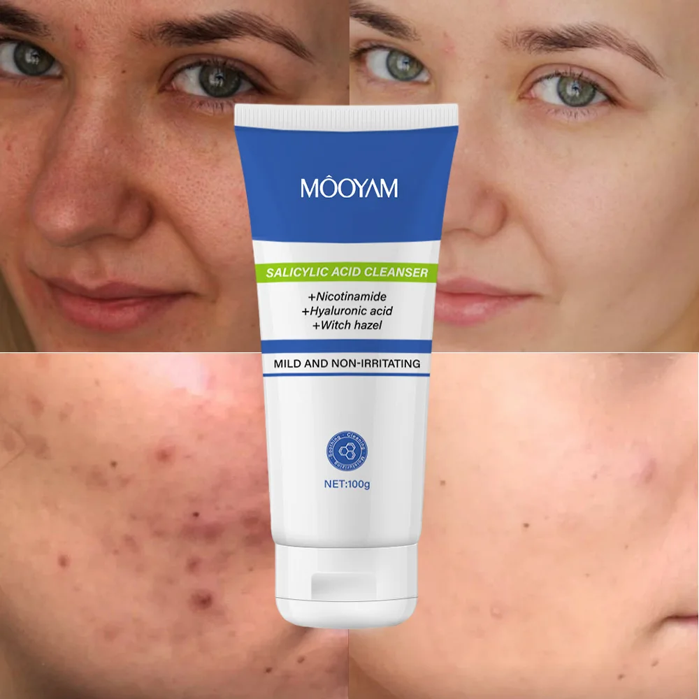 Niacinamide Salicylic Acid Cleanser Deep Gentle Cleansing Moisturizing Not Tight Witch Hazel Salicylic Acid Facial Cleanser
Niacinamide Salicylic Acid Cleanser Deep Gentle Cleansing Moisturizing Not Tight Witch Hazel Salicylic Acid Facial Cleanser