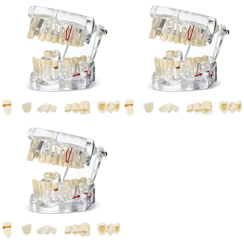 ABIT 3X Disease Teeth Model Typodonts Implant Teeth Model With Removable Teeth Dentist Standard Tooth Demonstration
ABIT 3X Disease Teeth Model Typodonts Implant Teeth Model With Removable Teeth Dentist Standard Tooth Demonstration
