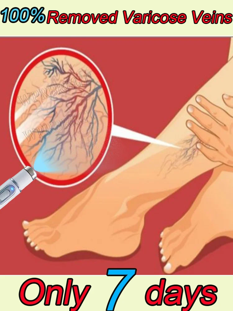 The second generation of varicose vein laser pen quickly eliminates the problem of veins
The second generation of varicose vein laser pen quickly eliminates the problem of veins