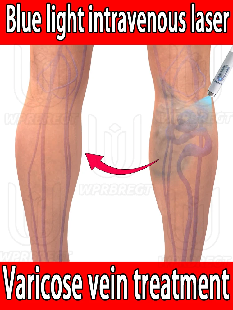 Effectively relieves dilated vasculitis in the legs and eliminates varicose veins, can help with scars, acne marks
Effectively relieves dilated vasculitis in the legs and eliminates varicose veins, can help with scars, acne marks