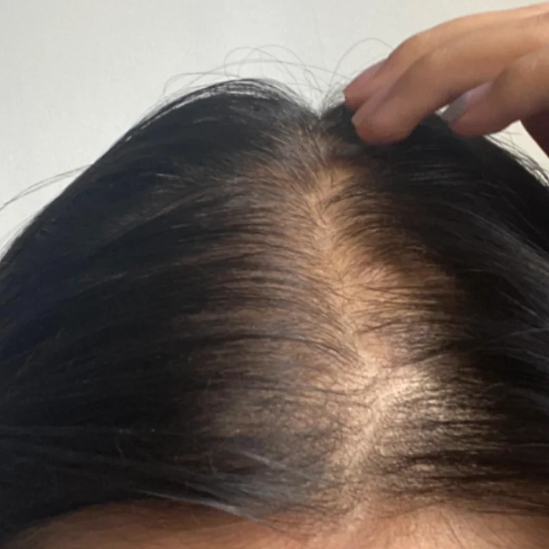 High Power 96 Laser Cap Low Level Laser Therapy for Androgenetic Alopecia Hair Regrowth Superior Coverage Management
High Power 96 Laser Cap Low Level Laser Therapy for Androgenetic Alopecia Hair Regrowth Superior Coverage Management