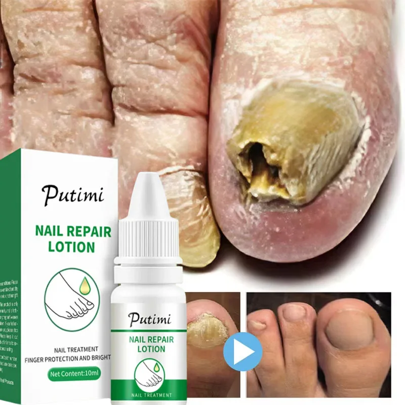 

Fungal Nail Treatment Oil Foot Repair Essence Toe Nail Fungus Removal Gel Anti Infection Cream Fungal Nail Removal