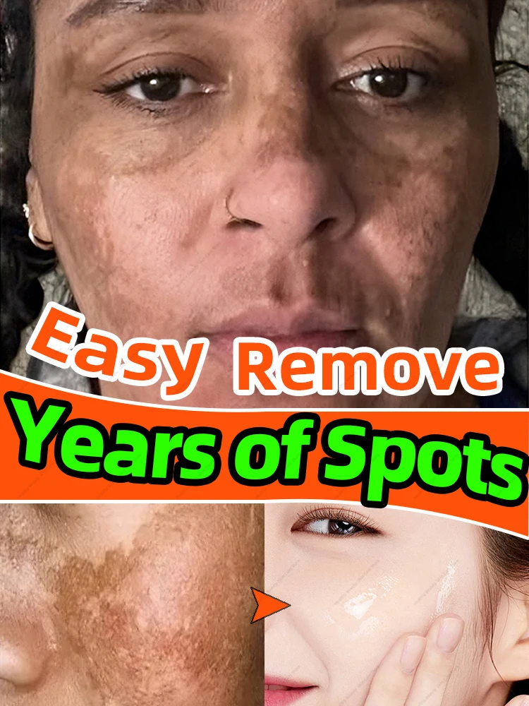 Remove All Spots Freckles Cream Dark Spot Remover for Face Melasma Removal