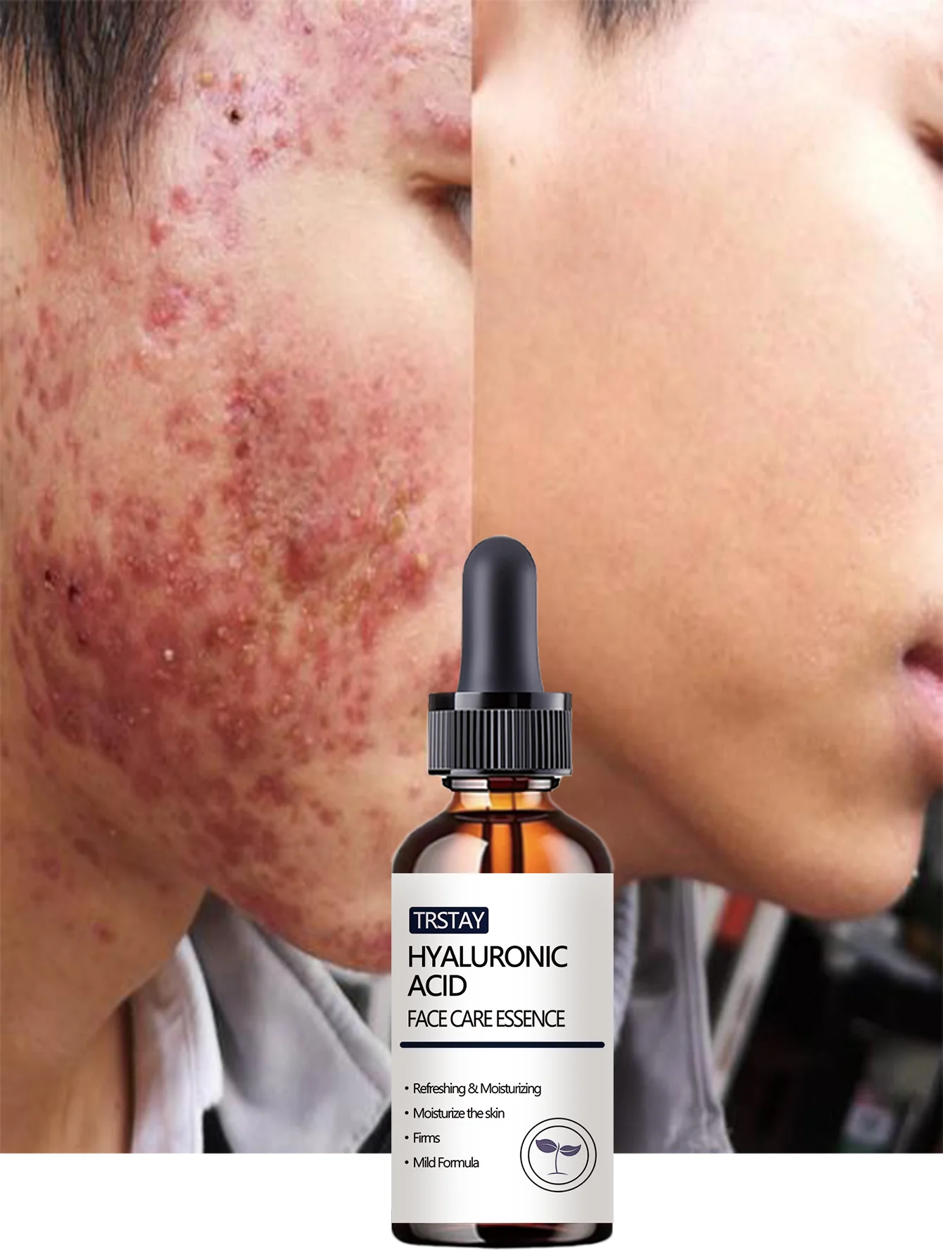 Acne-Fighting Essence, With Plant Extracts, Lightweight & Non-Greasy, Unscented, Suitable for All Skin Types, Hydrating, Gentle
