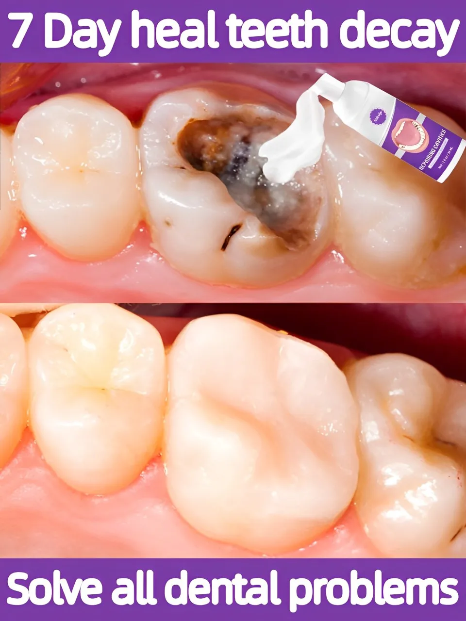 Tooth decay repair