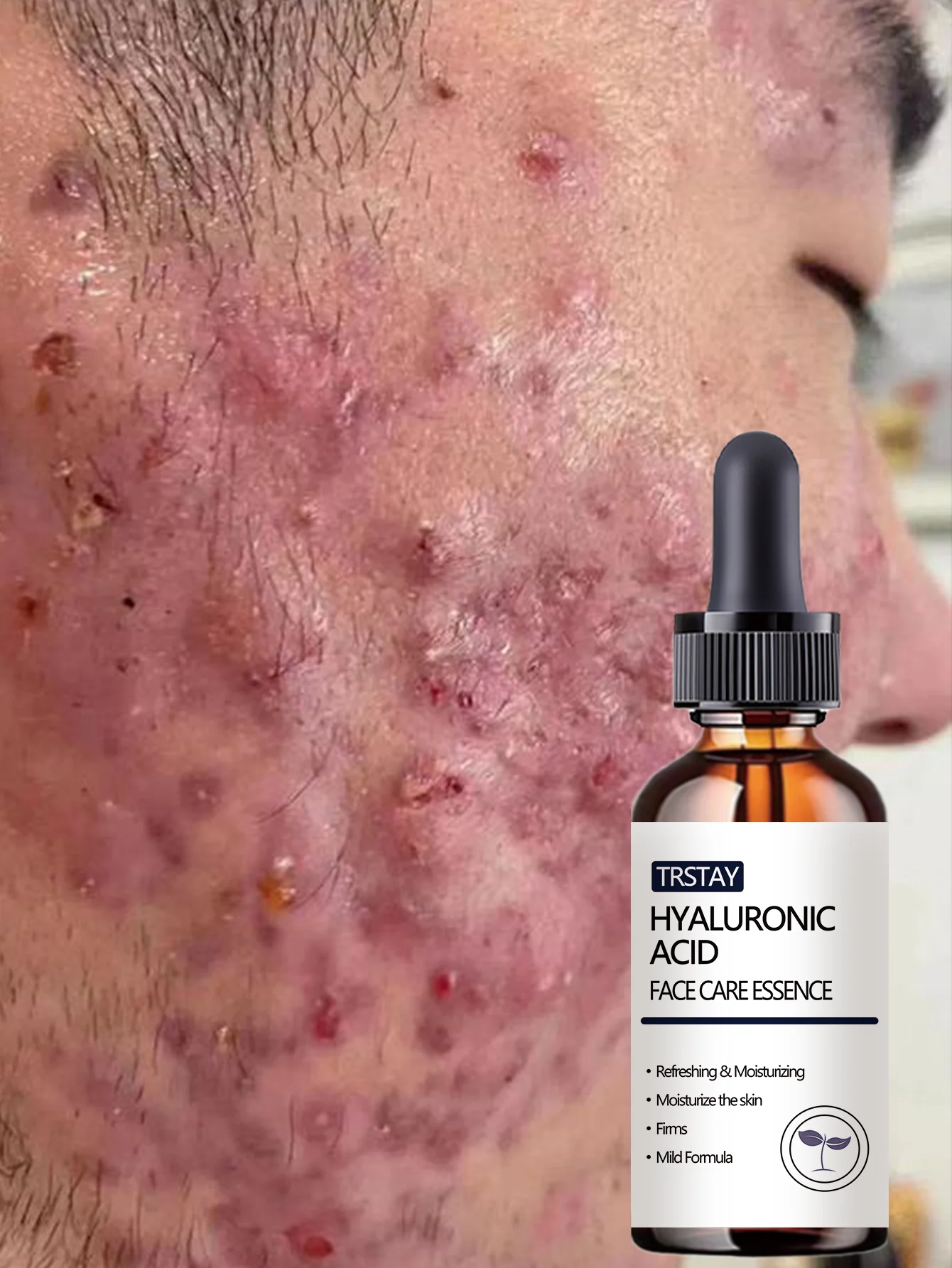 Acne-Fighting Essence, With Plant Extracts, Lightweight & Non-Greasy, Unscented, Suitable for All Skin Types, Hydrating, Gentle - Image 5