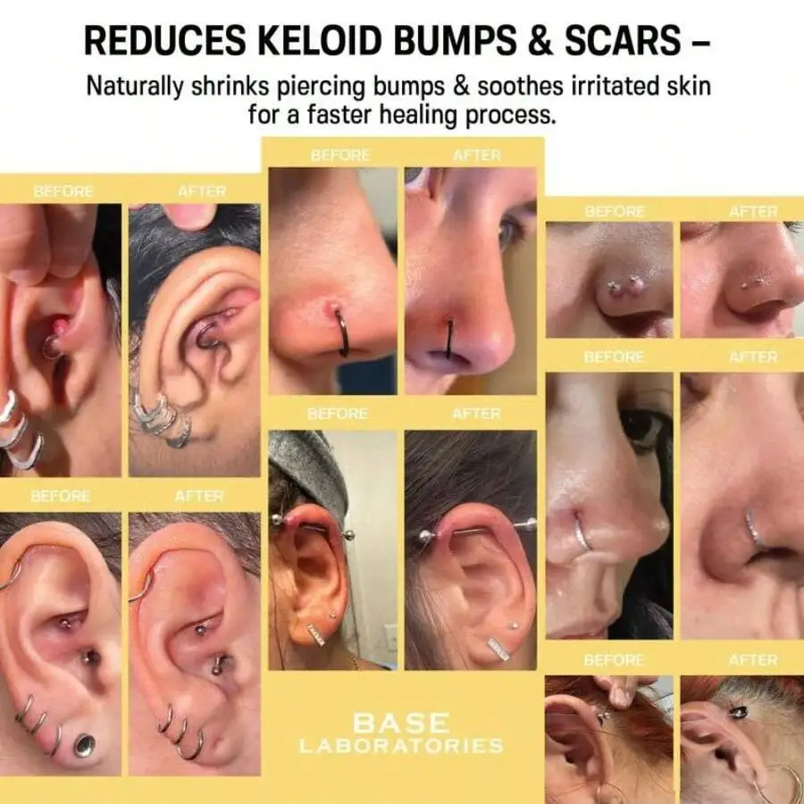 BASE LABORATORIES Solución para Protuberancias de Piercing y Eliminación de Queloides | Cuidado Calmante para Después del Piercing para Eliminar las Protuberancias y las Cicatrices Queloides | Aceite para el Cuidado Posterior de Queloides en Nariz y Oído