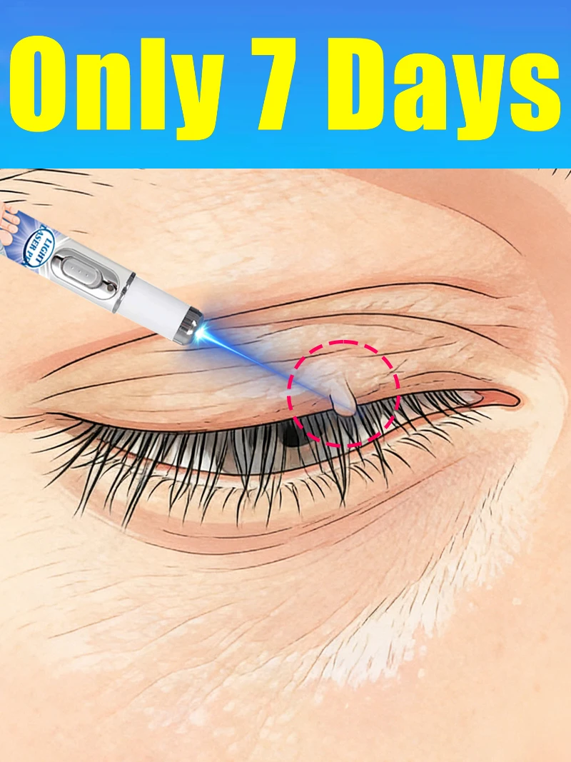 

НОВИНКА 2026: Ручка с синим светом для удаления бородавок на шее, инструменты для ухода за бородавками