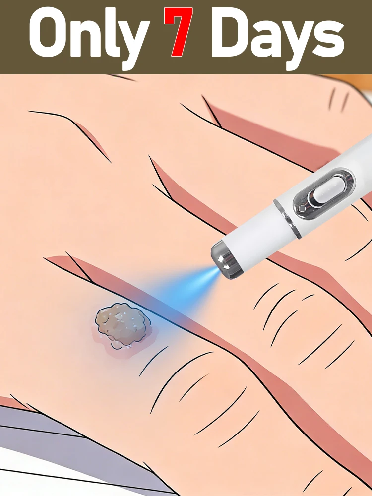 

Ручка для удаления кожных наростов, бережное удаление бородавок, подходит для всех частей тела.